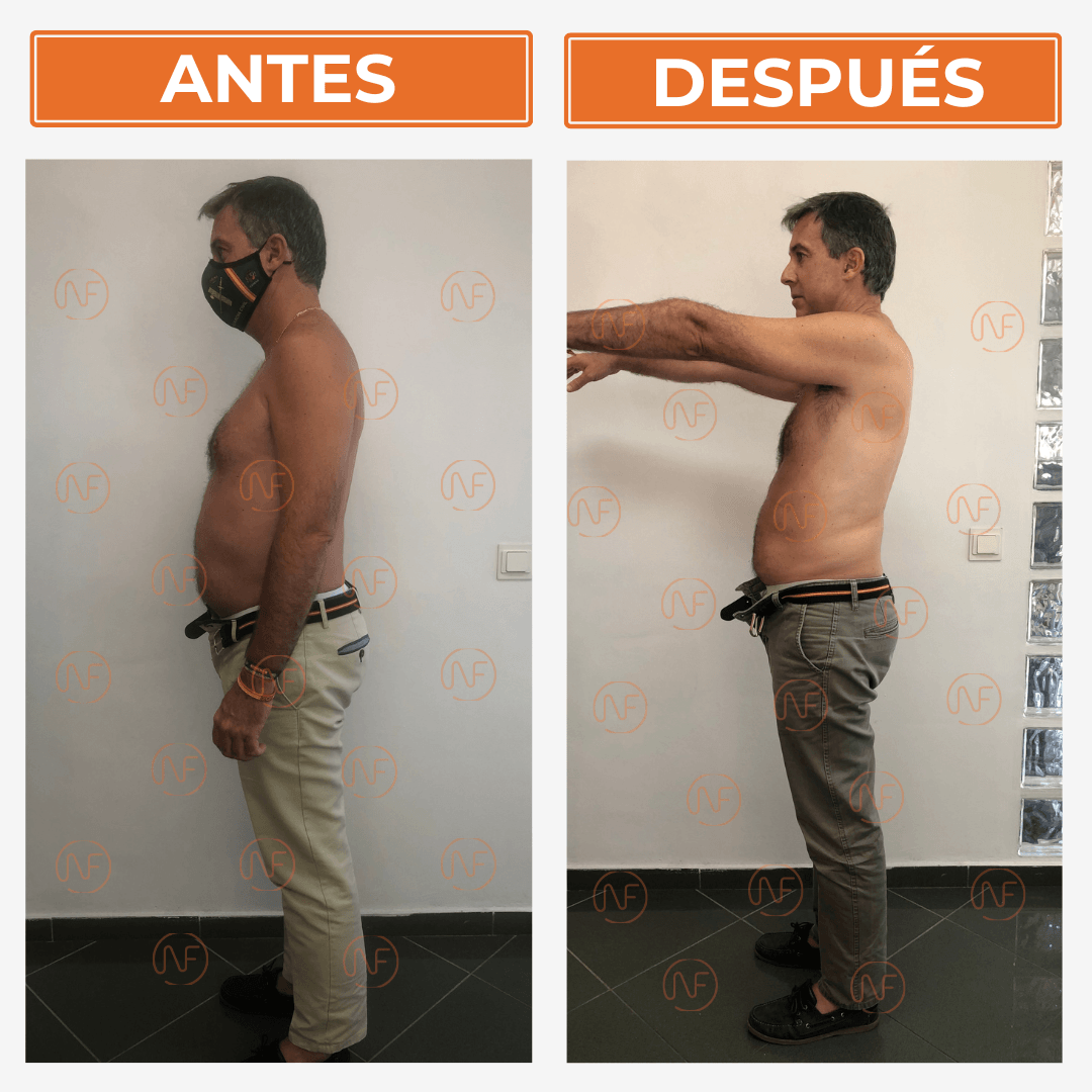 Antes y después de perfil tras perder 10 kg en 2 meses Pedro Barceló